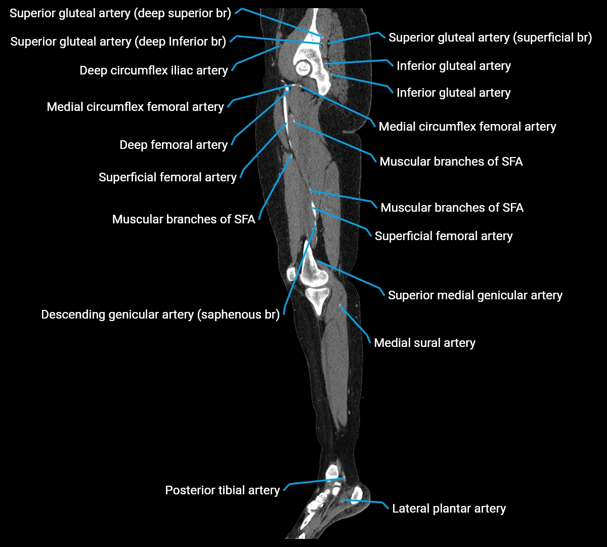 CTA lower limb sagittal cross sectional anatomy labelled image _33 (3).webp